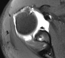 Failed Open Stabilisation MRI 2